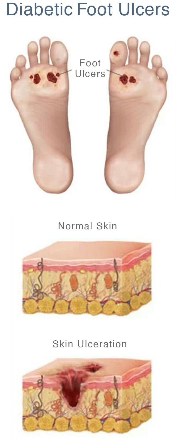 Foot Ulcers - Hills Podiatry Centre